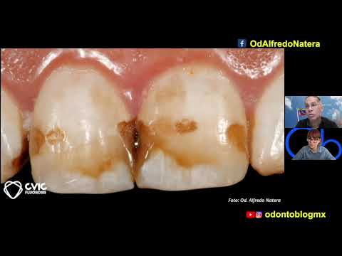 Fluorosis dental 🦷