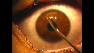Manual corneal epithelial removal