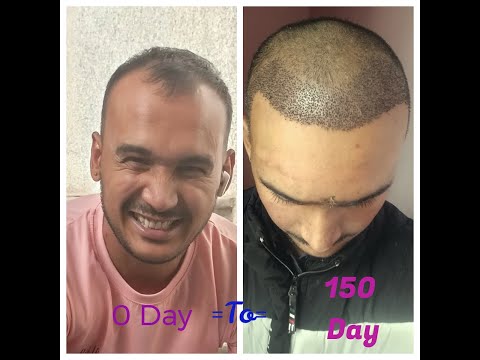 "From Bald to Bold: 5 Month Hair Transformation"