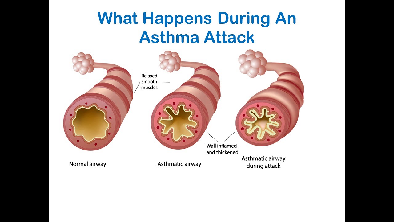 Managing An Asthma Attack