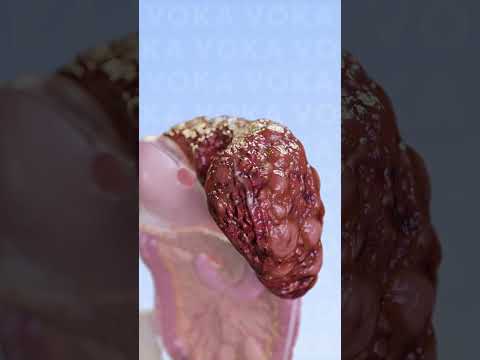 Liver Cirrhosis The Silent Killer You Need to Know About 3D visualization with VOKA Anatomy Pro