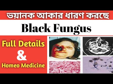 Black Fungus l Mucormycosis Fungal Infection l ব্ল্যাক ফাঙ্গাস ইনফেকশন । কারণ লক্ষণ । Homeopathic ।