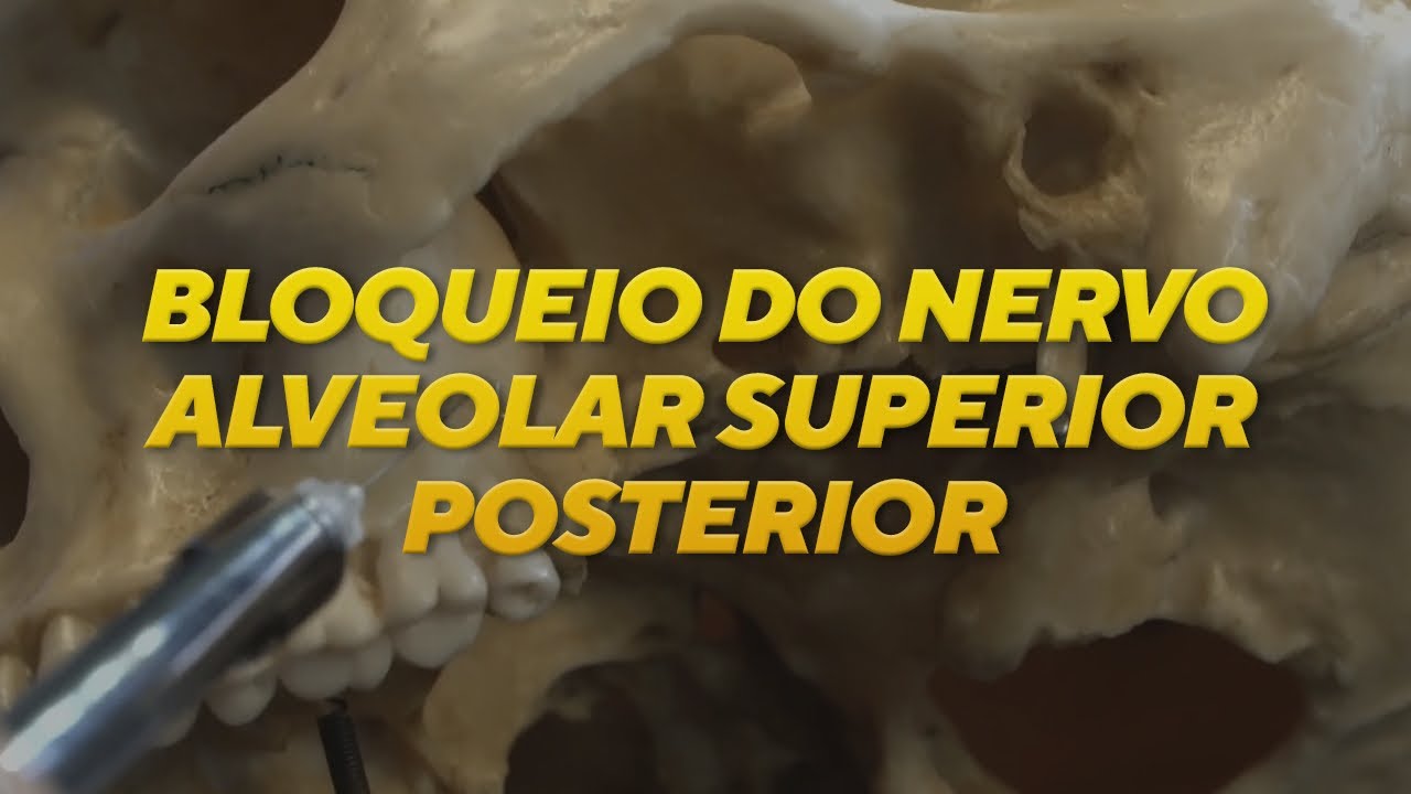Bloqueio do nervo alveolar superior posterior (NASP): EM MENOS DE 2 MINUTOS!