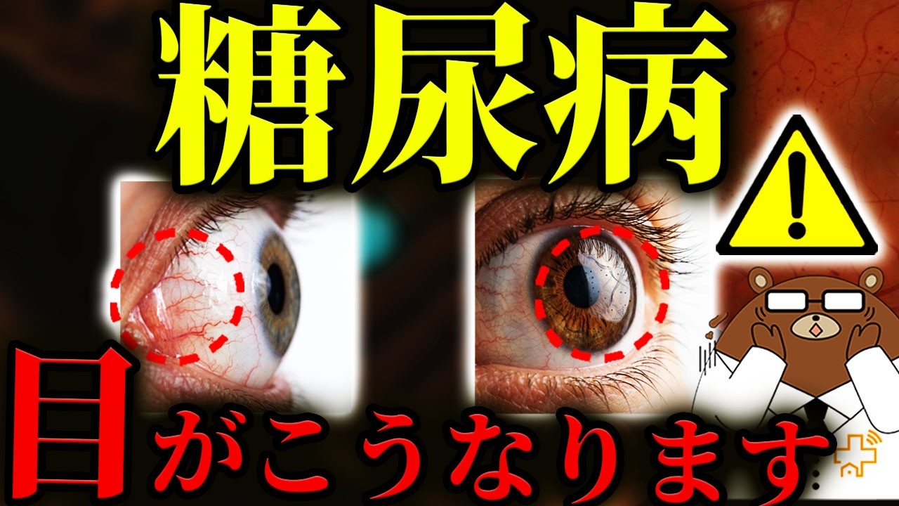 放置厳禁！知らないと後悔する糖尿病の「目」の初期症状。かすみ・ゆがみ・飛蚊症..絶対に見逃してはいけない失明の危険サインとは？自分で気づける目のチェック方法とは？医師が徹底解説！