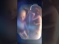 Twins Fighting in Mother's Womb #shorts - Friendly Health Twins Fighting in Mother's Womb #shorts