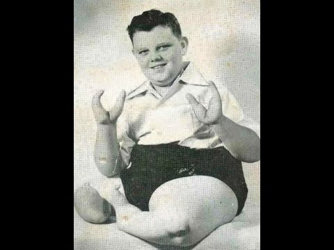 The Shocking Life & Death of Grady Stiles 😱 | The Real “Lobster Boy” Story