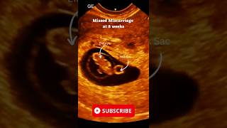 Download lagu Missed Miscarriage at 8 Weeks Ultrasound  Scan mp3