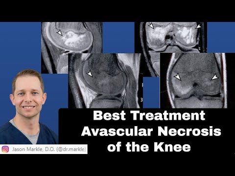 Avascular Necrosis of the Knee: Best Treatment Options