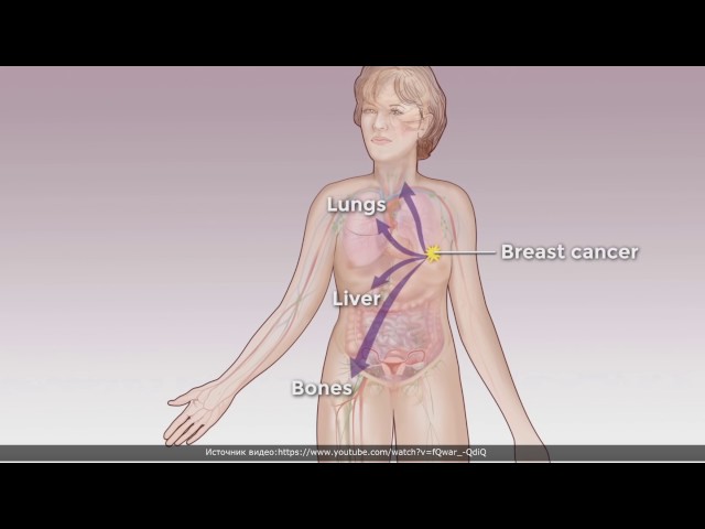 Рак Матки Метастазы В Легких Лечение