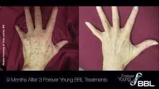 Forever Young Broad Band Light Treatment