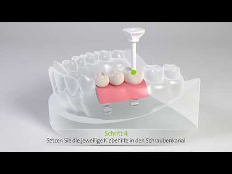 Straumann® Variobase® Klebehilfe