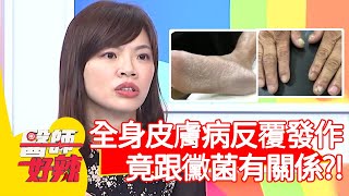 全身皮膚病反覆發作，竟跟黴菌有關係？！【#醫師好辣】20201221 part2 EP1070 陳保仁 宋明樺