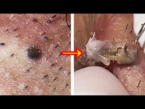 Blackhead removal Video #16 #Blackheads #blackheadsremoval #sebum