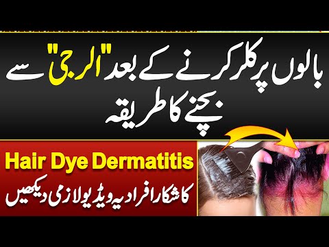Hair Color Sy Allergy Ka ilaj- Hair Dye Dermatitis- Hair Dye Reactions- Hair Color Allergy Treatment