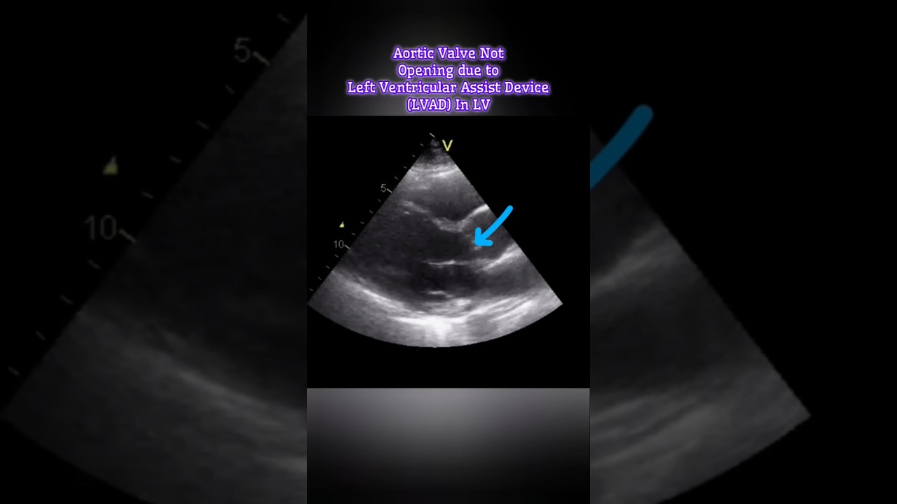 Left Ventricular Assist Device(LVAD) In LV #aorticvalve #heart #Echo