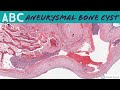 Aneurysmal Bone Cyst ABC 5 Minute Pathology Pearls