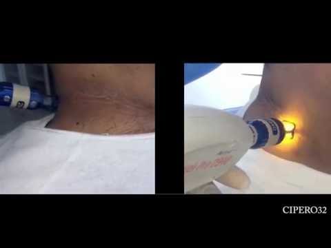 Fototerapia di prezzo di lentiggini I posti di pigmentary su un corpo sono bombardati da una fotografia che questo