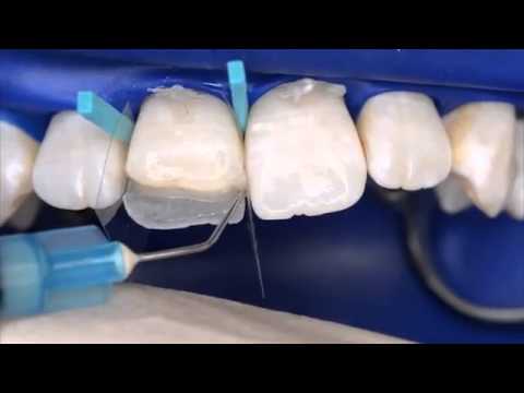 Henry Schein UK -- How to Create an aesthetic ANTERIOR restoration using Filtek™ Supreme XTE
