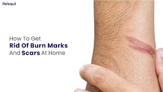 How To Get Rid Of Burn Marks And Scars At Home