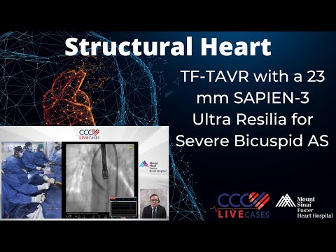 TF-TAVR with a 23 mm SAPIEN-3 Ultra Resilia for﻿Severe Bicuspid AS
