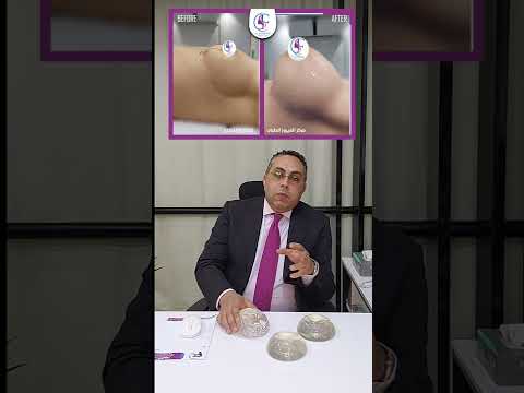 breast augmentation by silicon implant