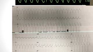 Arritmias cardíacas na emergência