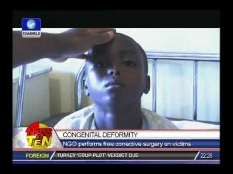 FREE  FACIAL DEFORMITY SURGICAL OUTREACH PROGRAMME