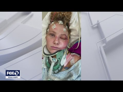 Bay Area travel blogger recovers from severe brain trauma, shares survival story