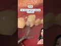 Getting A Teeth Cleaning After 5 Years Teethcleaning Tartarremoval Plaque Tartar