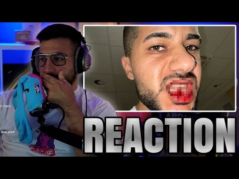 MERT REAGIERT AUF HAMEDLOCO KIEFER GEBROCHEN..