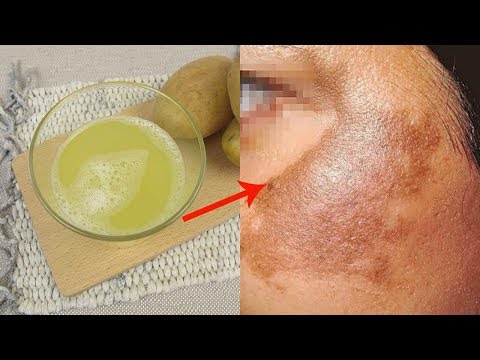 download lagu mp3 mp4 Manchas Na Cara Como Eliminar, download lagu Manchas Na Cara Como Eliminar gratis, unduh video klip Manchas Na Cara Como Eliminar