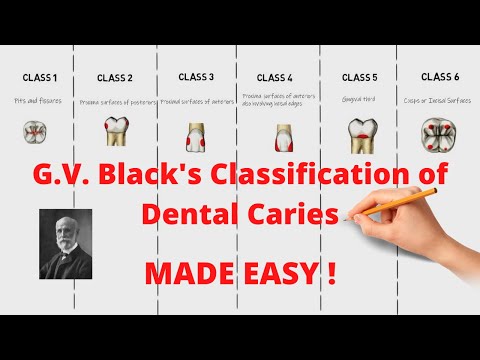 G.V. Black's Classification of Dental Caries (Quick and Complete Revision)