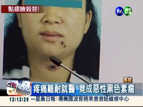 點痣變惡性色素瘤 女子險毀容