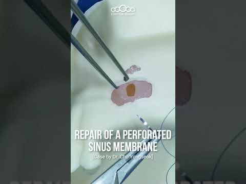 Repair of a perforated sinus membrane #shorts
