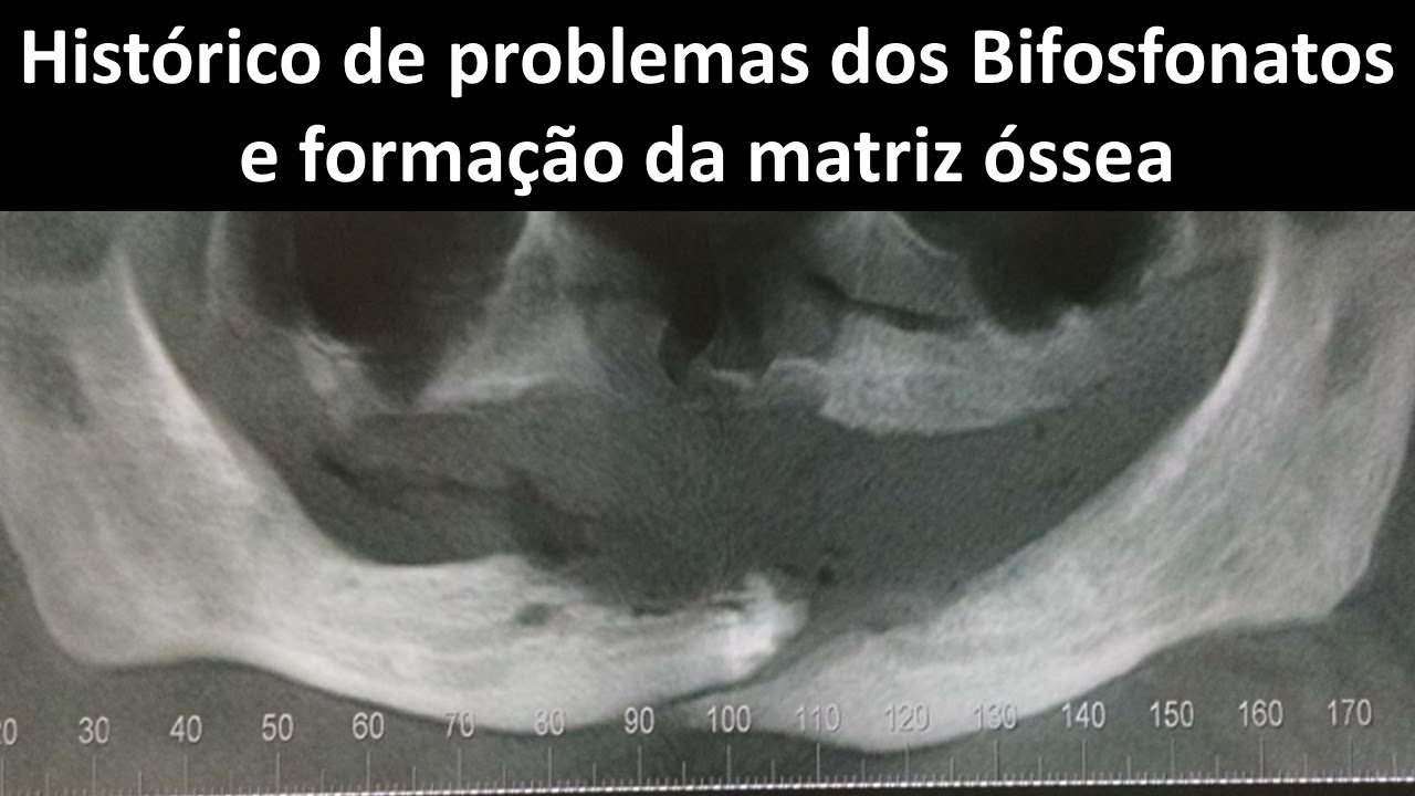Histótico de problemas dos Bifosfonatos e formação da matriz óssea | Odontologia | Dra Bianca Rosa