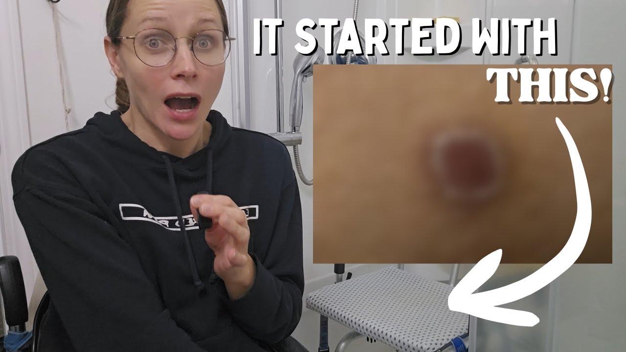 How I Got a Stage 1 Pressure Sore (And How Fast It Happened)