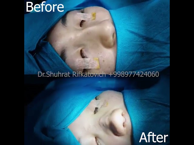 Rinoplastika +998977424060 Dr Shuhrat Rifkatovich