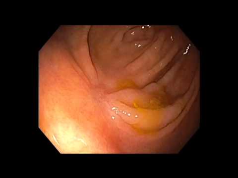 Coloscopie : mucosectomie endoscopique d'un polype festonné sessile du caecum attaché au mur