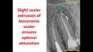 Healing of periapical lesions non surgically.