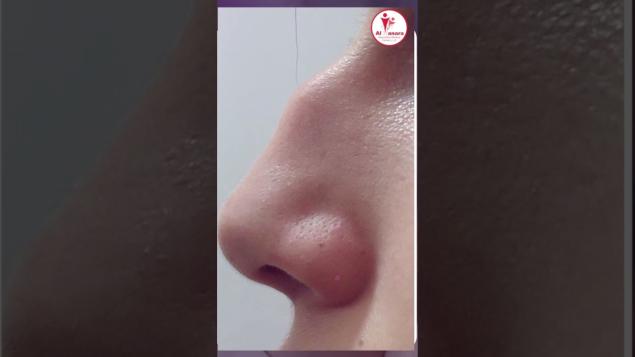 Nose Reshaping dubai