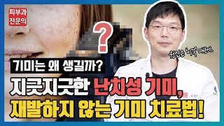 기미치료 재발없이 없애는 방법 #기미 #원인 #실펌엑스