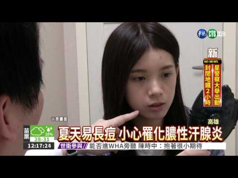 痘痘化膿別輕忽 汗腺炎會致命