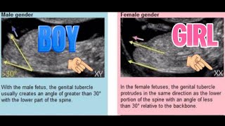 Baby Gender Prediction: Is The Nub Theory Accurate At Predicting Sex