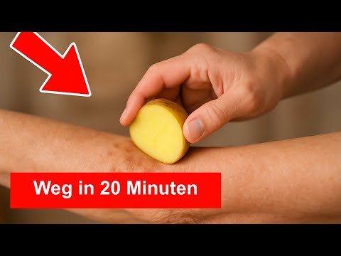 Altersflecken weg in nur 20 Minuten! Kartoffel & Ingwer wirken WUNDER 🍋✨1