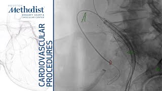 Download Lagu Iliac Branch Device and EVAR (Maham Rahimi, MD, M. Mujeeb Zubair, MD) Thumbnail