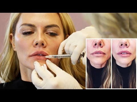download lagu mp3 mp4 Botox Lips, download lagu Botox Lips gratis, unduh video klip Botox Lips
