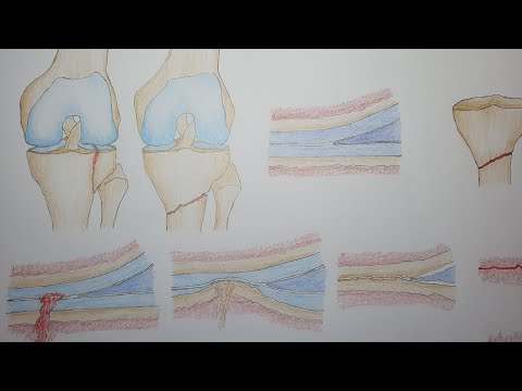 Intra articular VS Extra articular fractures