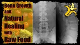 Bone Growth and Natural Healing with Raw Food