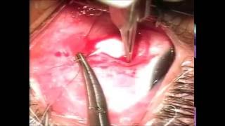 Cirugía de Estrabismo en niños: Dr Abel Flores Boza