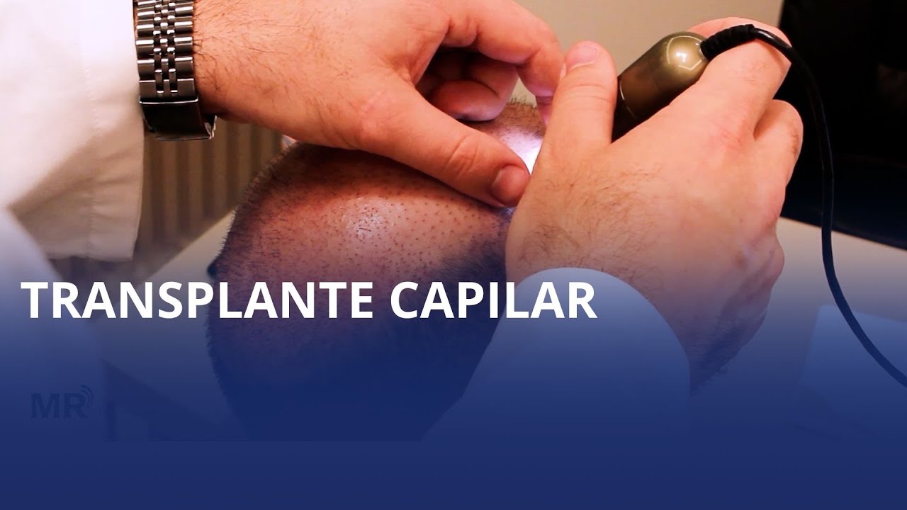 Transplante capilar é o assunto da dica, com o dr Renato Brandt